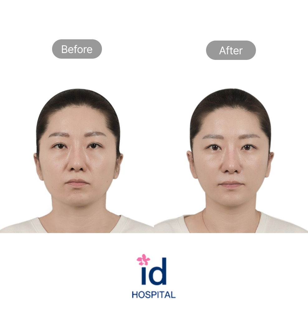 Non-Incisional Double Eyelid Surgery, Epicanthoplasty, and Under Eye Fat Repositioning Before and After Result at ID Hospital