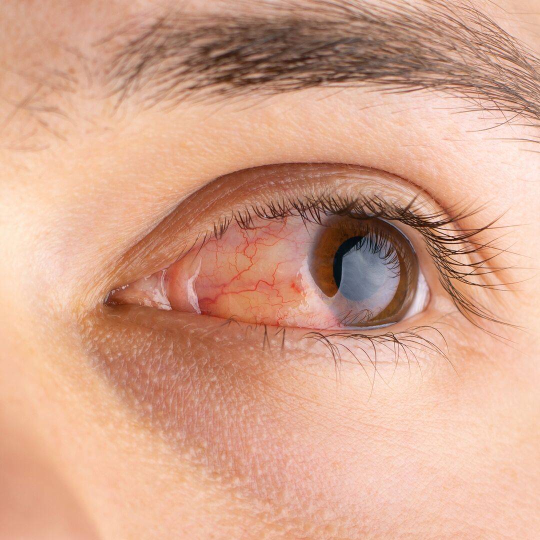 Ein rotes, tränendes und gereiztes Auge mit einer allergiebedingten Bindehautentzündung.