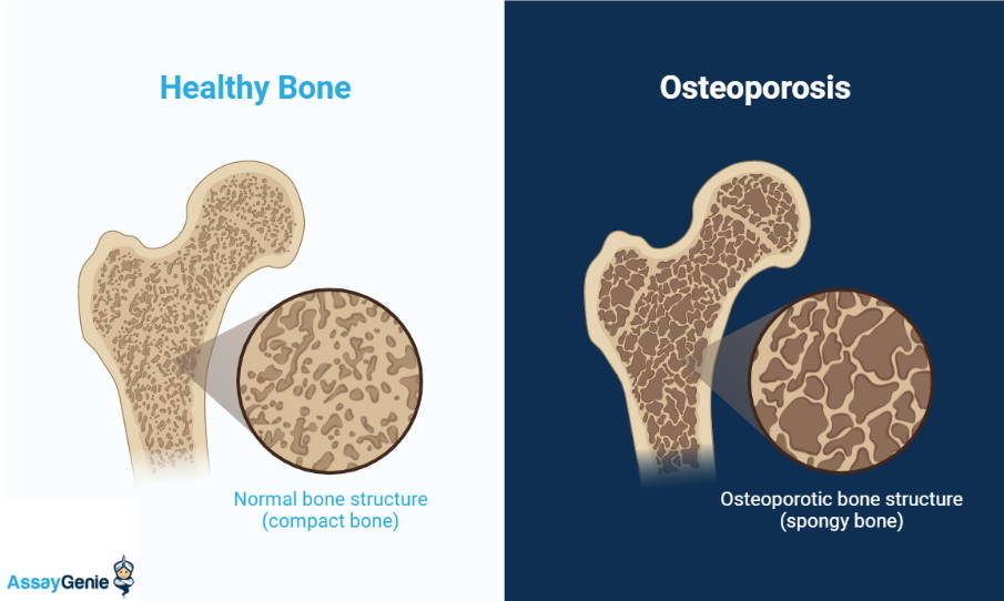 Schematic of healthy vs osteoporotic bone