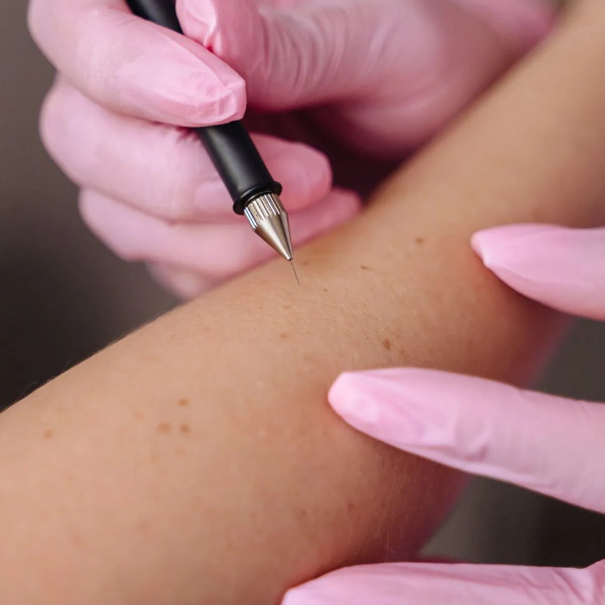 Therapist performing electrolysis on a client.