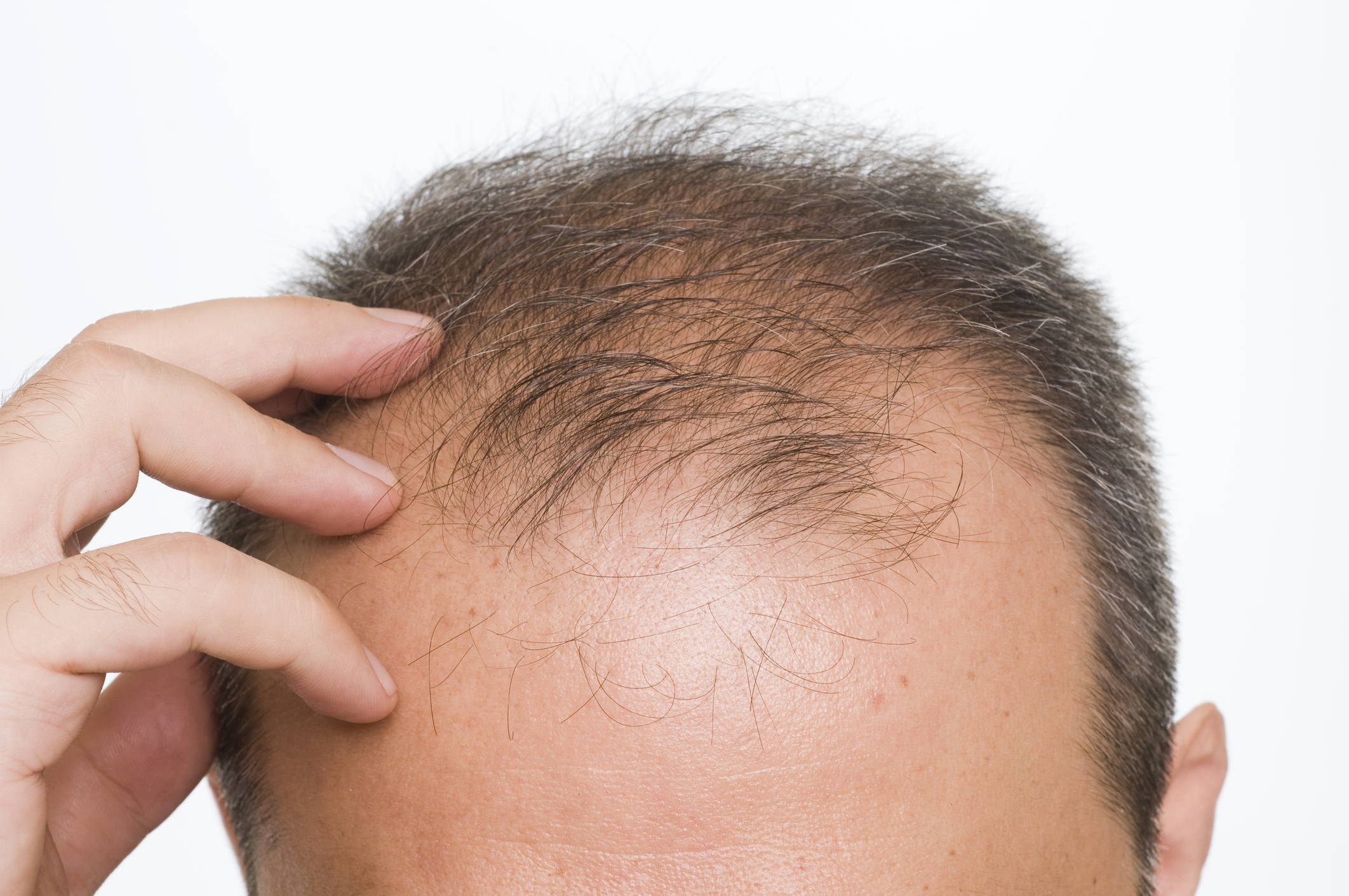 Can Topical Retinoids Cause Hair Loss? – DS Healthcare