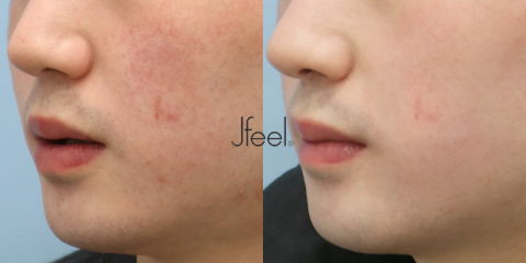 Male Rosacea Laser Treatment Before and After for Persistent Facial Redness