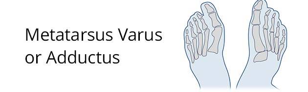 Metatarsus Varus or Adductus