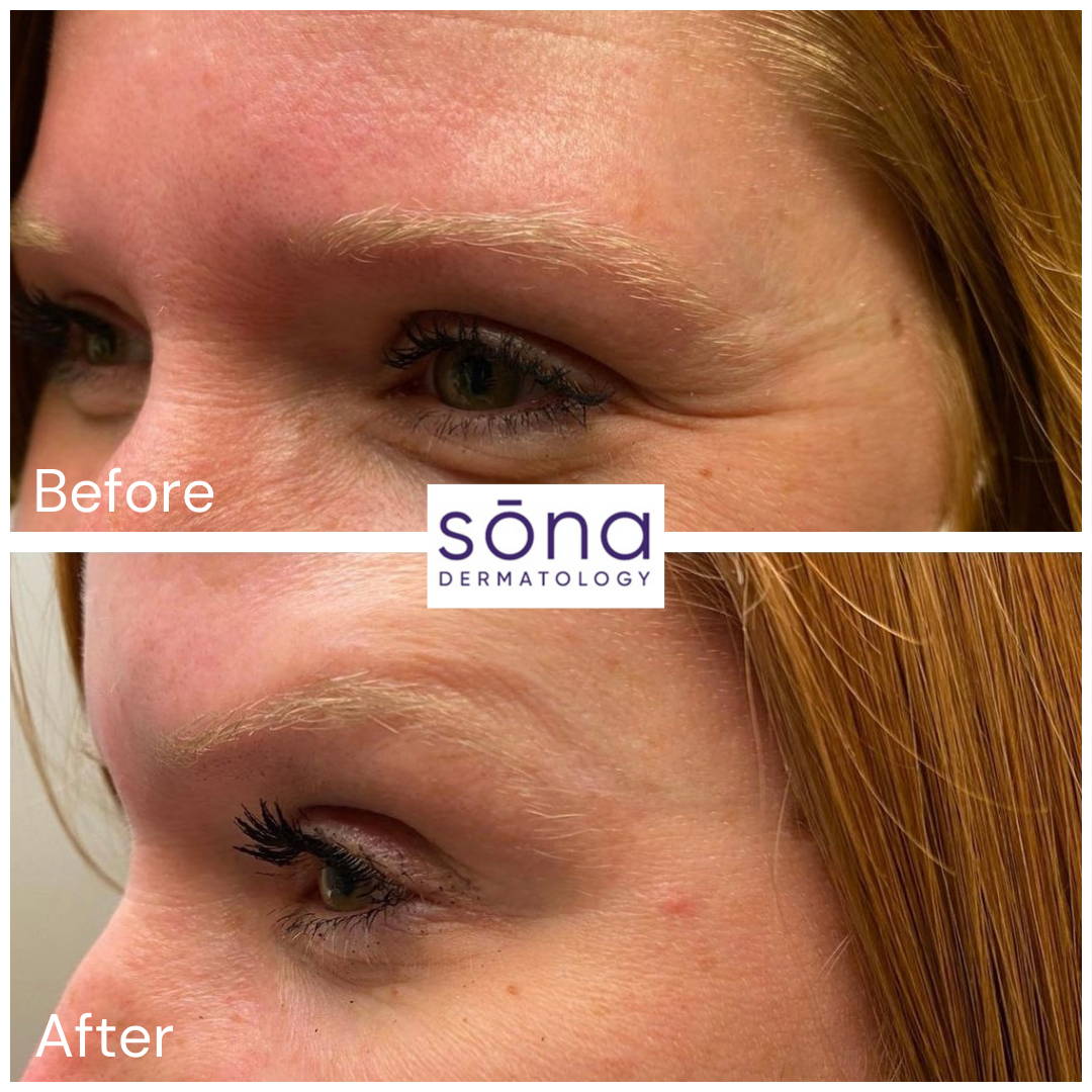 Sona Botox Cosmetic Before & After