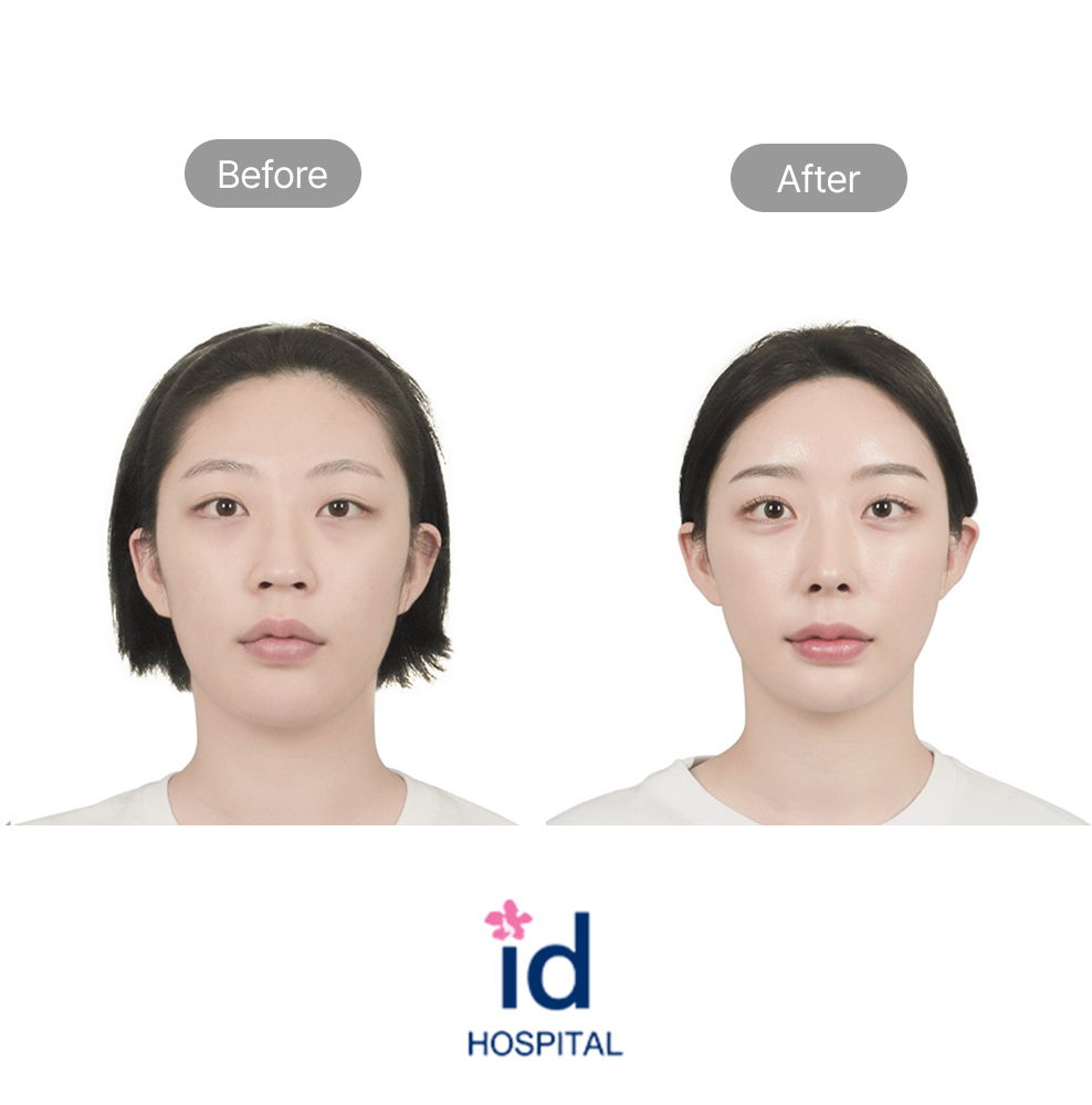 Glamorous Rhinoplasty Before and After Result at ID Hospital