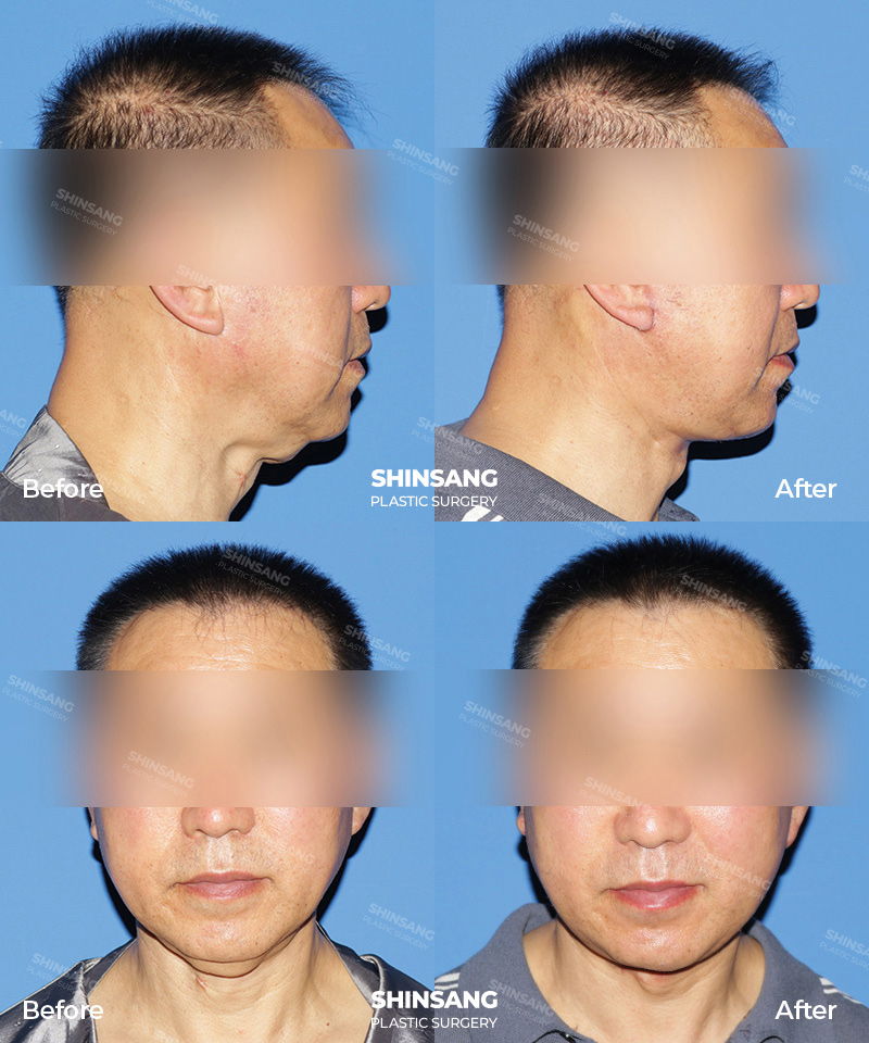 Toad Neck Neck Reduction Surgery Result Review At Sinsang Plastic Surgery In Korea
