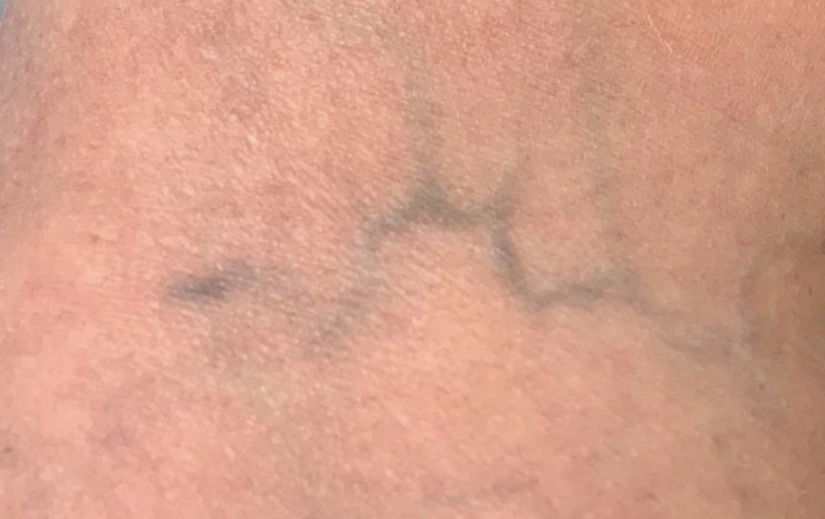 Reticular Veins