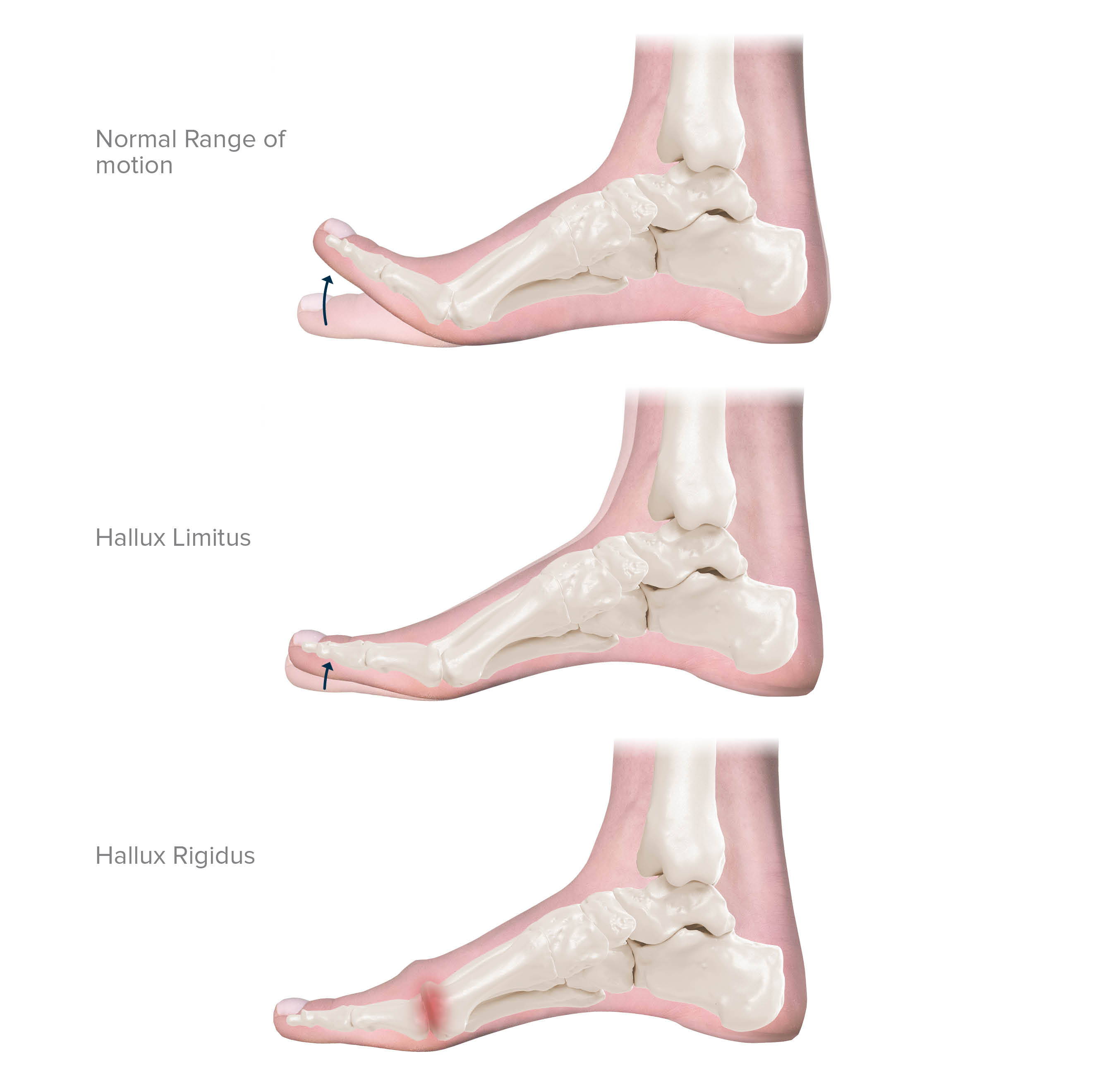 Hallux Rigidus