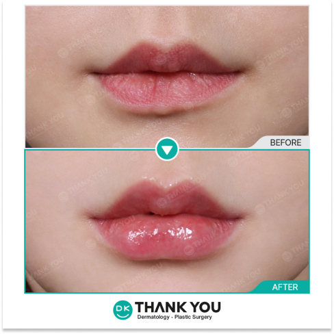 Lip asymmetry correction before and after using filler and botox for improved lip balance and symmetry