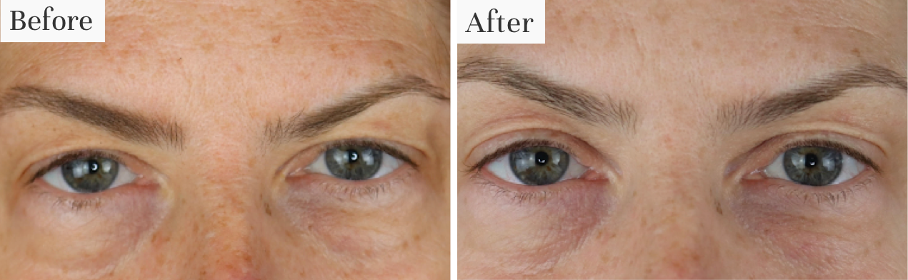 Comparison of eyes before and after treatment, showing visible improvement.