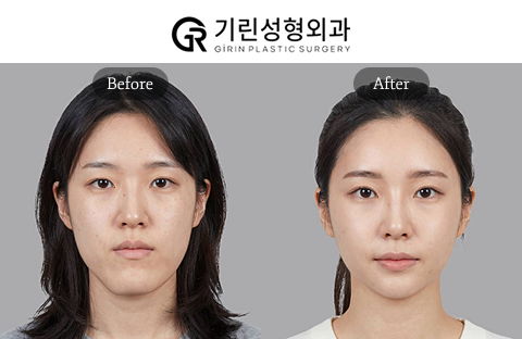 Before and After Face Contouring Surgery in Plastic Surgery Korea Including V Line Surgery and Face Fat Removal