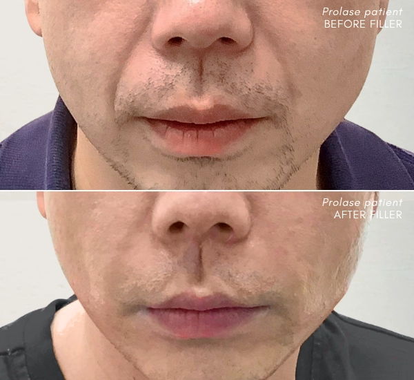 Prolase Patient before and after Juvederm Vollure in nasolabial folds with Voluma in Cheeks and chin Laila Khalaj