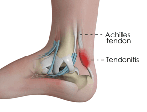 the achilles tendon
