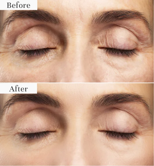 Before and after images showing eyelid appearance improvement.