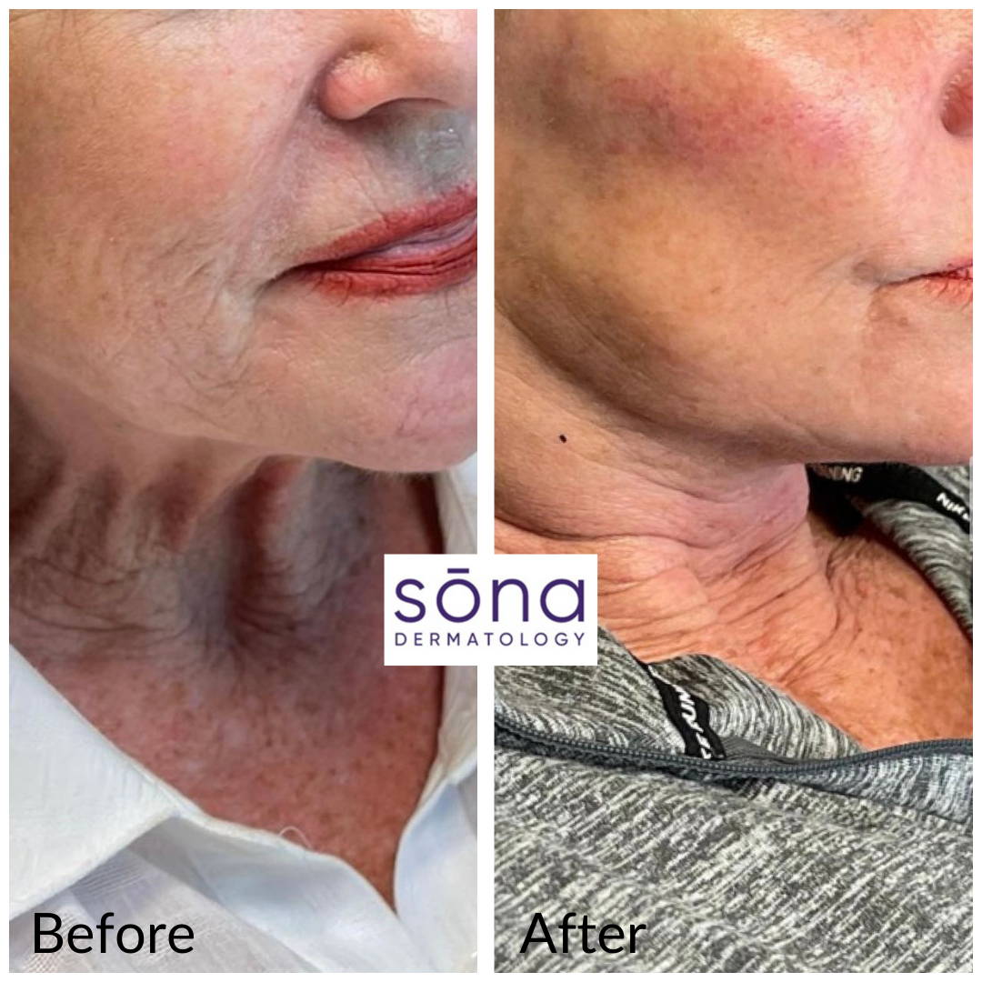 Sona Juvederm Facial Filler Before & After