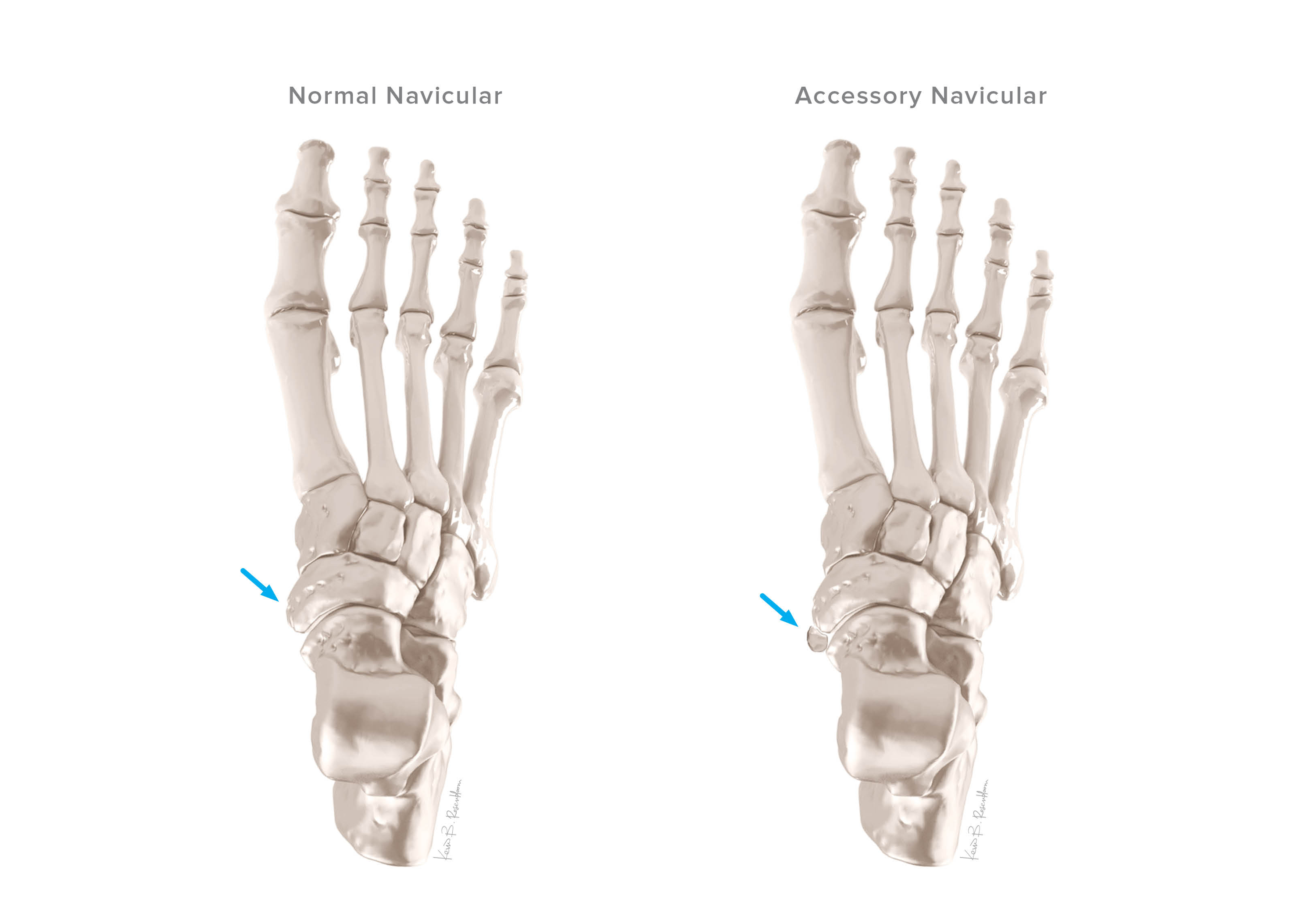 Accessory Navicular Syndrome