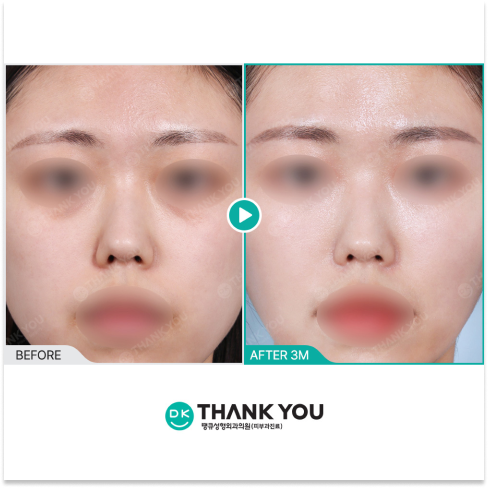 Juvelook Volume Before and After 3 Months for Natural Facial Volume in Korea