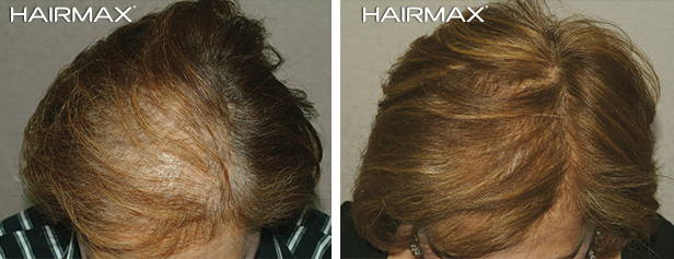 HairMax Before After
