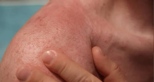  Fingers pressing on someone’s shoulder which looks red and itchy – it’s contact dermatitis
