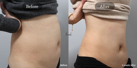 Non-Surgical Body Contouring in Korea with HIFU Body Tightening for Post-Ozempic Loose Skin and Waistline Definition
