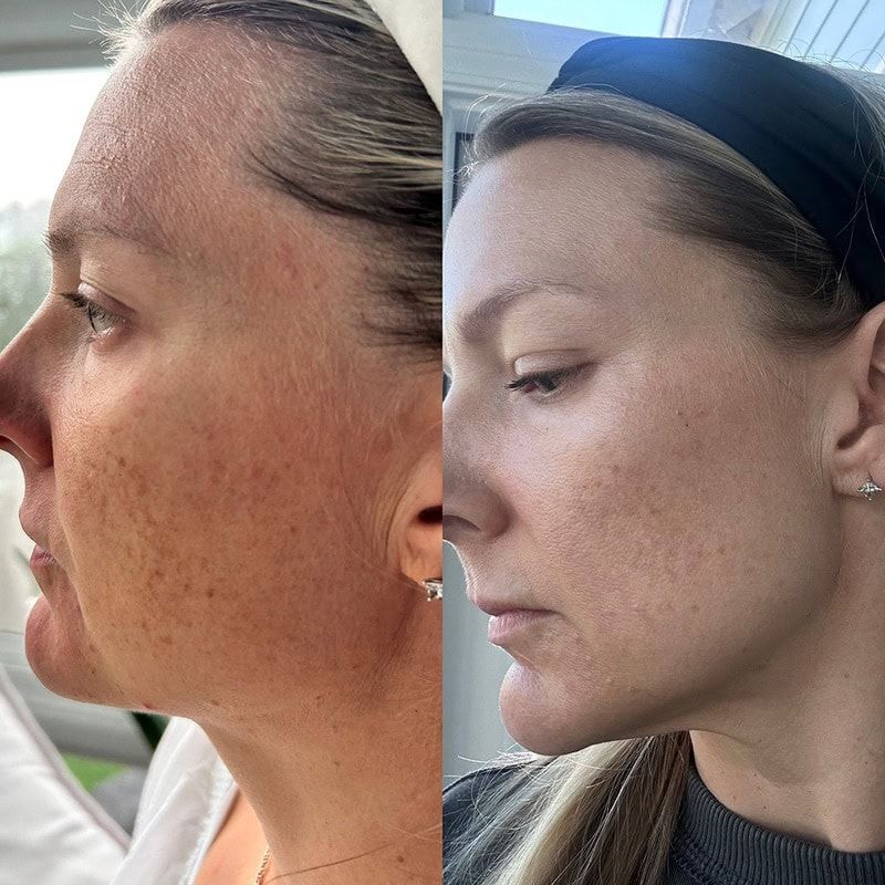 Before and after comparison of a woman's facial appearance.