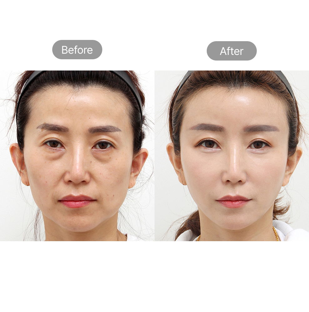 Anti-aging face lift before and after results for a younger facial appearance in Korea