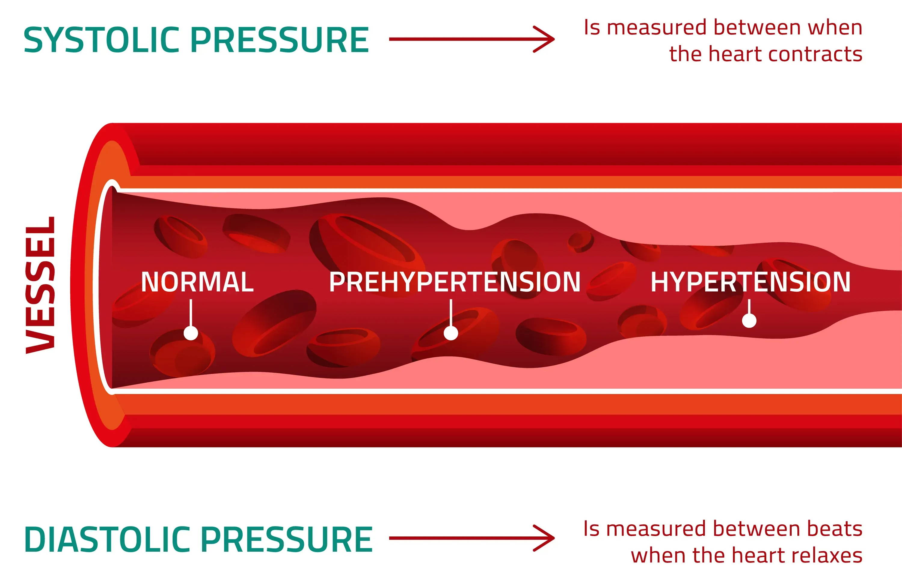 Animated graphic showing the difference between systolic pressure and diastolic pressure in the blood vessel. High blood pressure/hypertension animation.