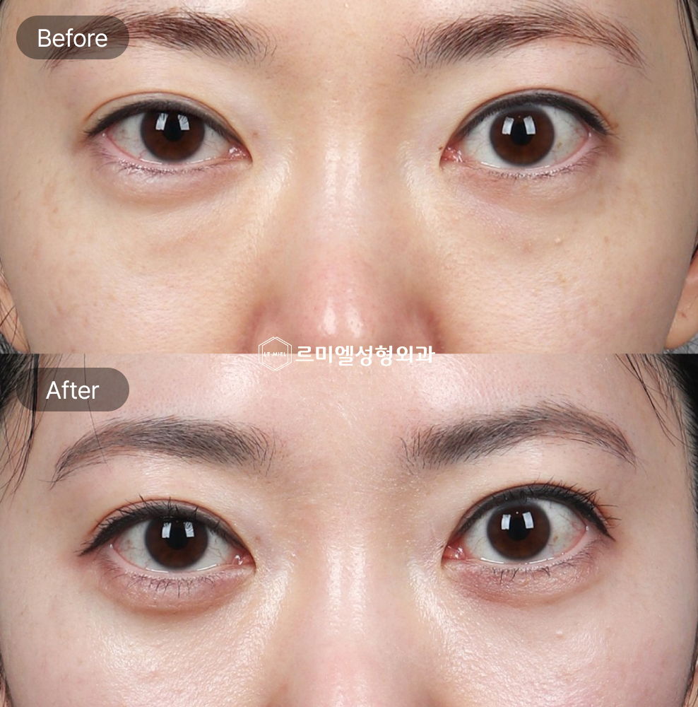 Before and After Results of Under Eye Fat Repositioning and Virtue RF Treatment After Seven Months