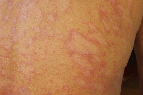 Fotos de piel afectada por eczema