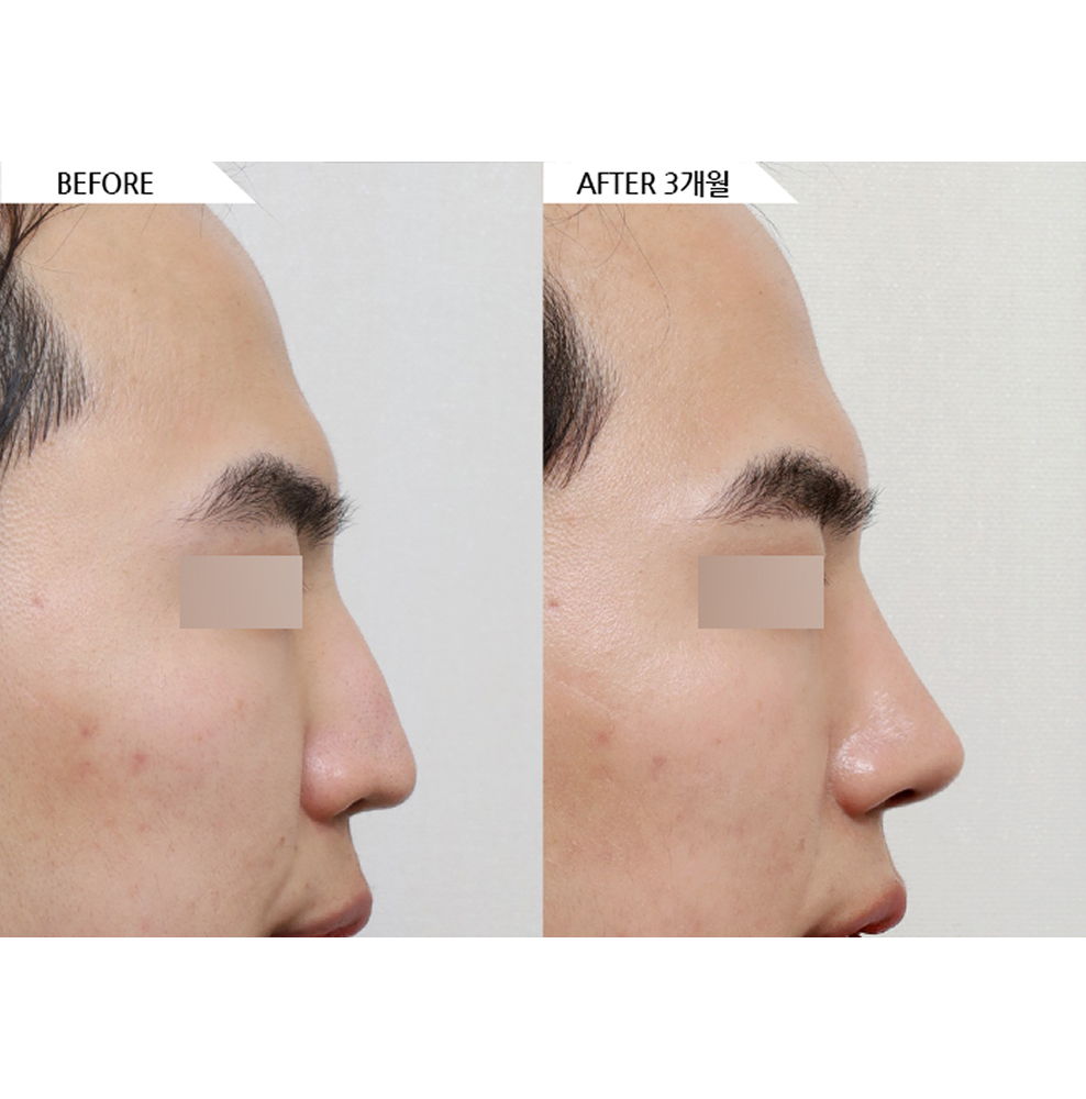 Before and after male rhinoplasty showing a more defined nose bridge and refined side profile with natural results 3 months after surgery in Korea