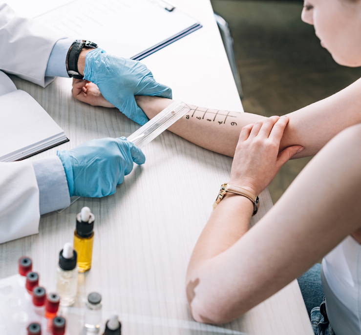Doctor measuring the raised bumps on her patient’s arm as part of skin prick test – one type of dust mite allergy test