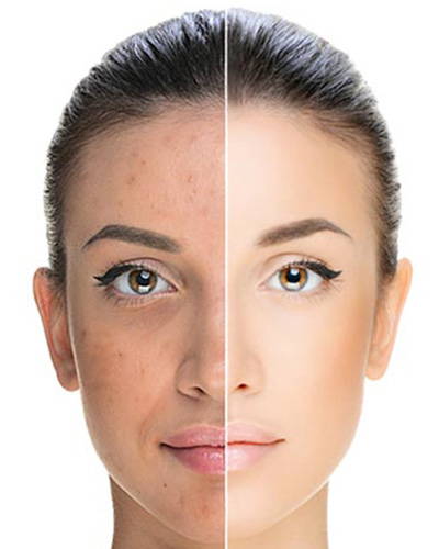 BEFORE AND AFTER CHEMICAL PEEL BENEFITS