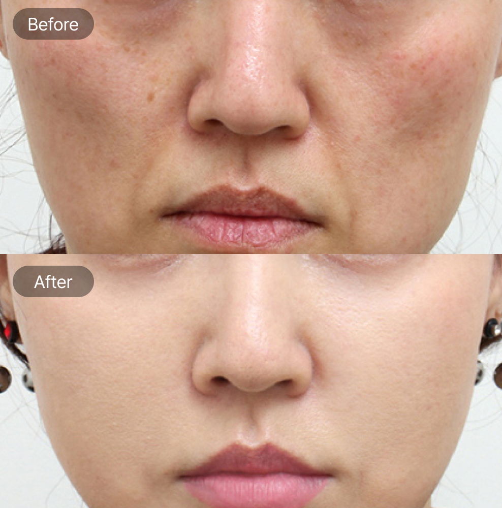 Midface fat grafting before and after results for cheek volume restoration in Korea