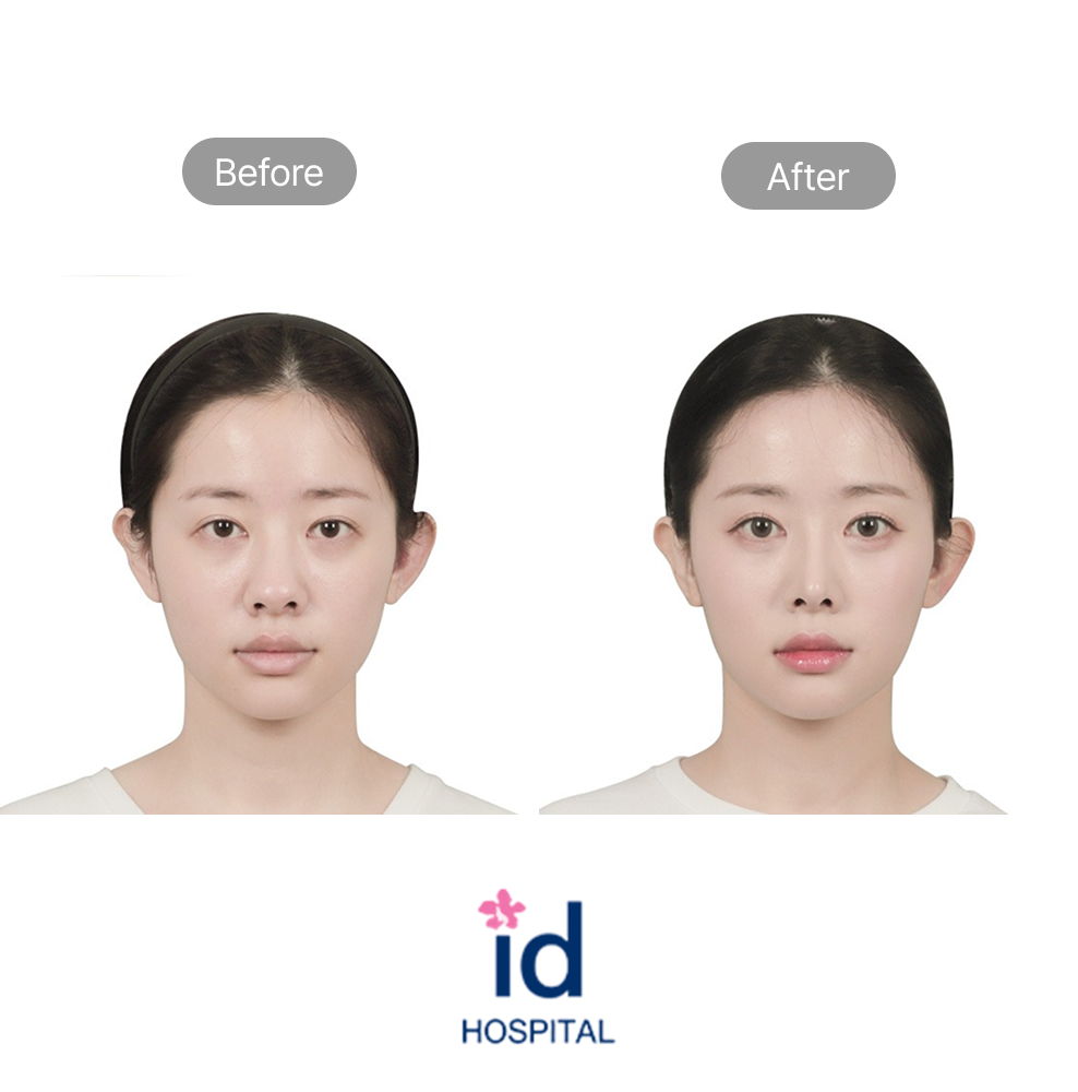 Rhinoplasty Before and After Result at ID Hospital