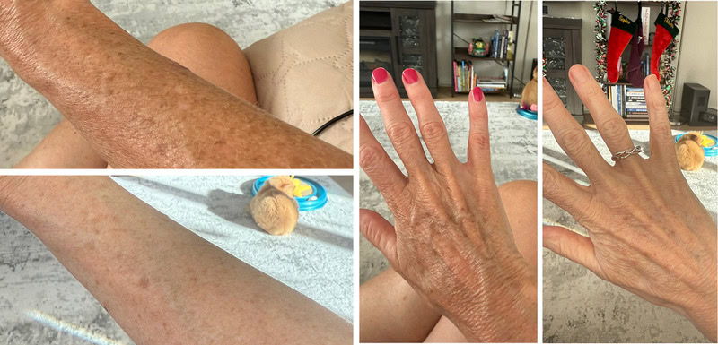 Close-up of hands and arms showing skin texture and nail polish.