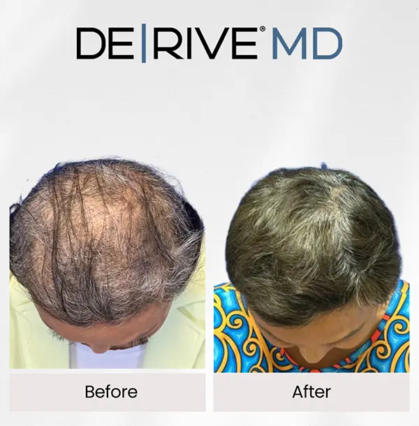 Hair growth after cancer