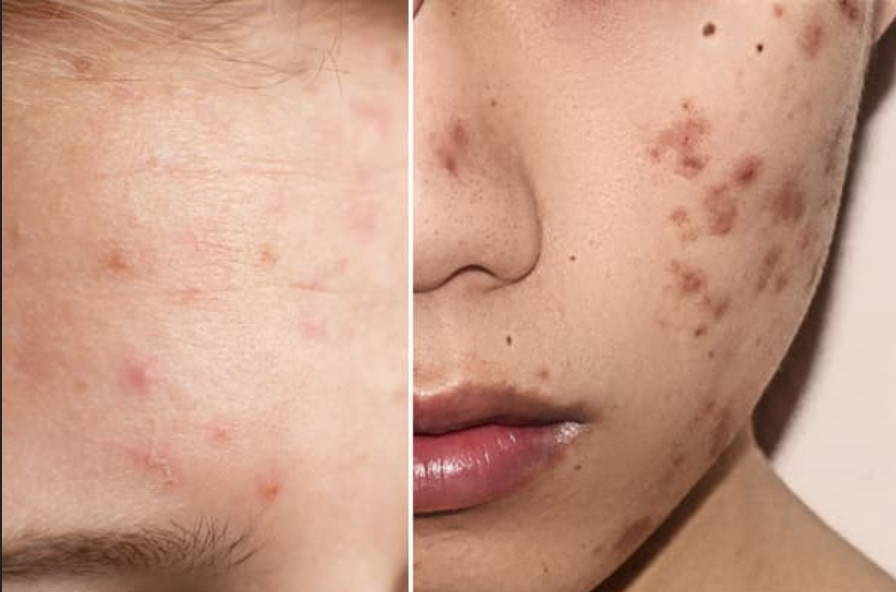 break outs in skin vs skin purging 