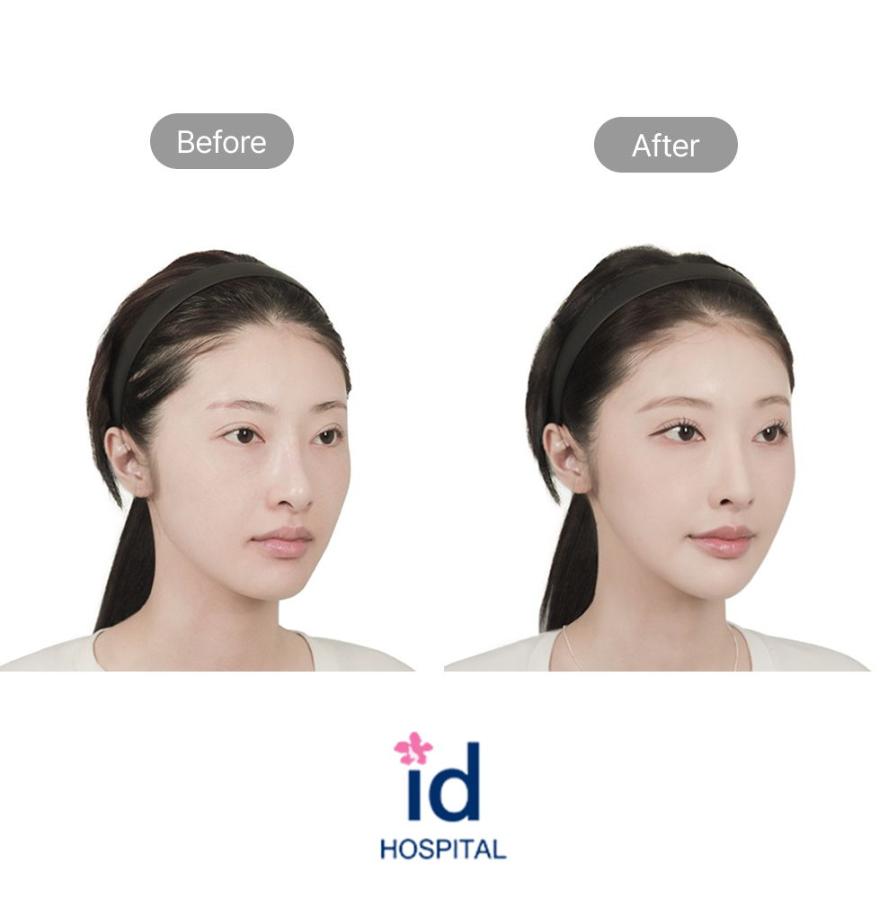 Revision Rhinoplasty and Functional Nose Surgery Before and After Result at ID Hospital