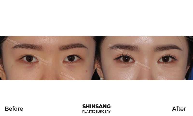 Buried Double Eyelid Surgery Result At Sinsang Plastic Surgery In Korea