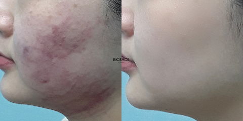 Severe acne improved through Korean combination laser treatments after clinical acne face scan and personalized Korean skin treatments
