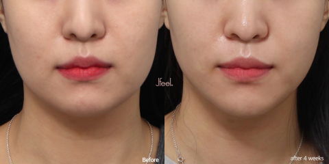 V-Shape Face Slimming Before and After in Korea Using Jaw Botox and Thread Lifting for a More Defined Lower Face and Facial Contour