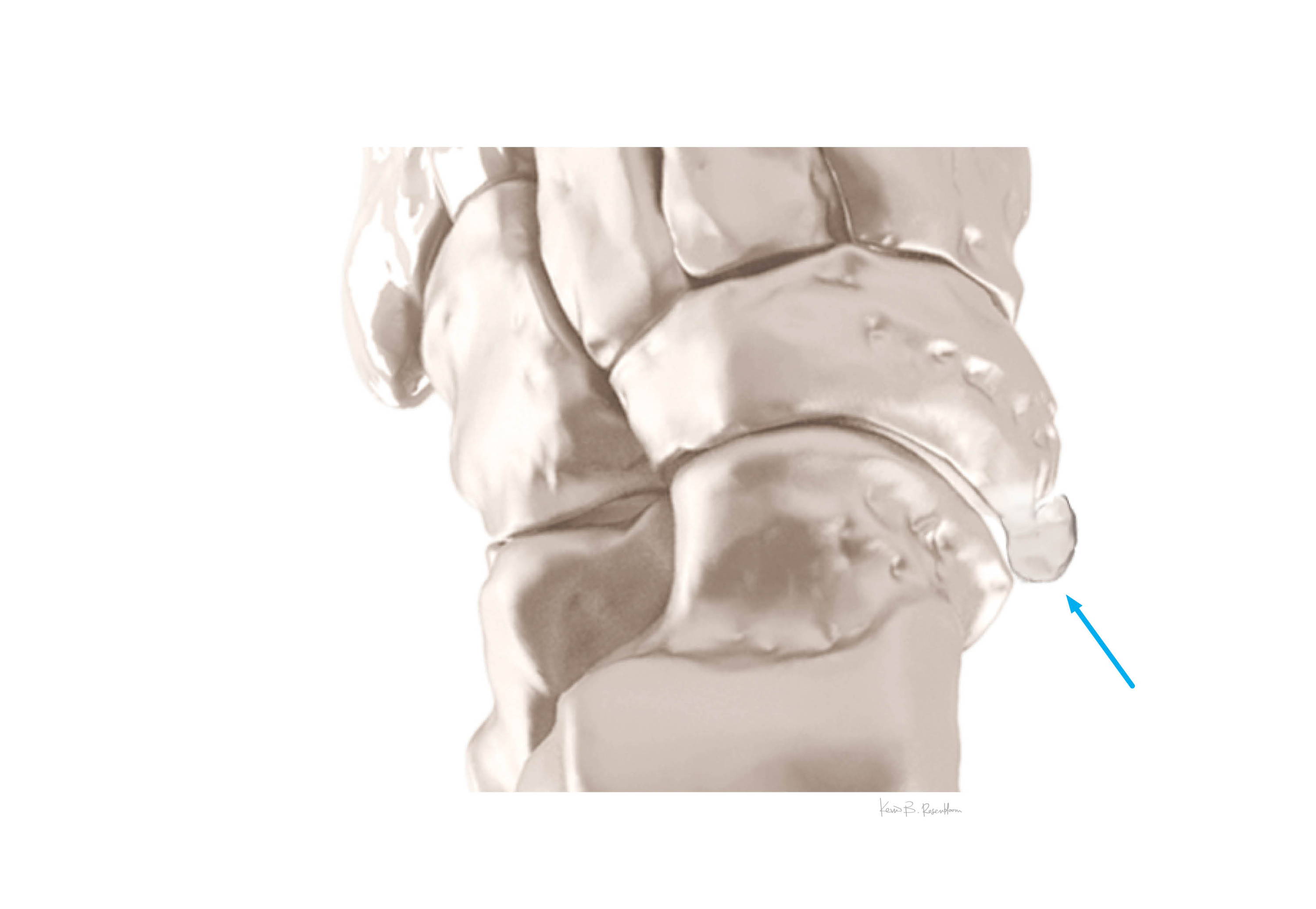 Accessory Navicular Syndrome