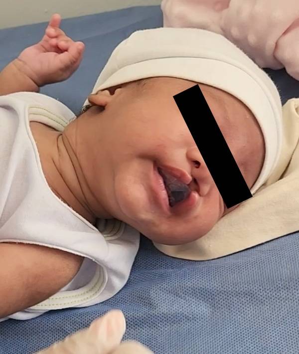 Jesús, bệnh nhân nam, 2 ngày tuổi, được chẩn đoán sứt môi và vòm miệng hoàn toàn 2 bên