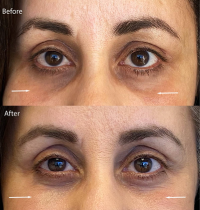 Under Eye Circles Before and After Using Skinuva Brite
