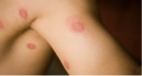 Person mit Ringelflechte, auf deren Arm und Achselhöhle sich die für Ringelflechte typischen runden Flecken befinden – rot, aber in der Mitte hell