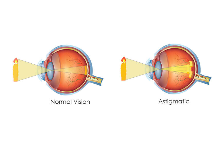 produse eficiente pentru miopie viziune fără ajutorul ochilor