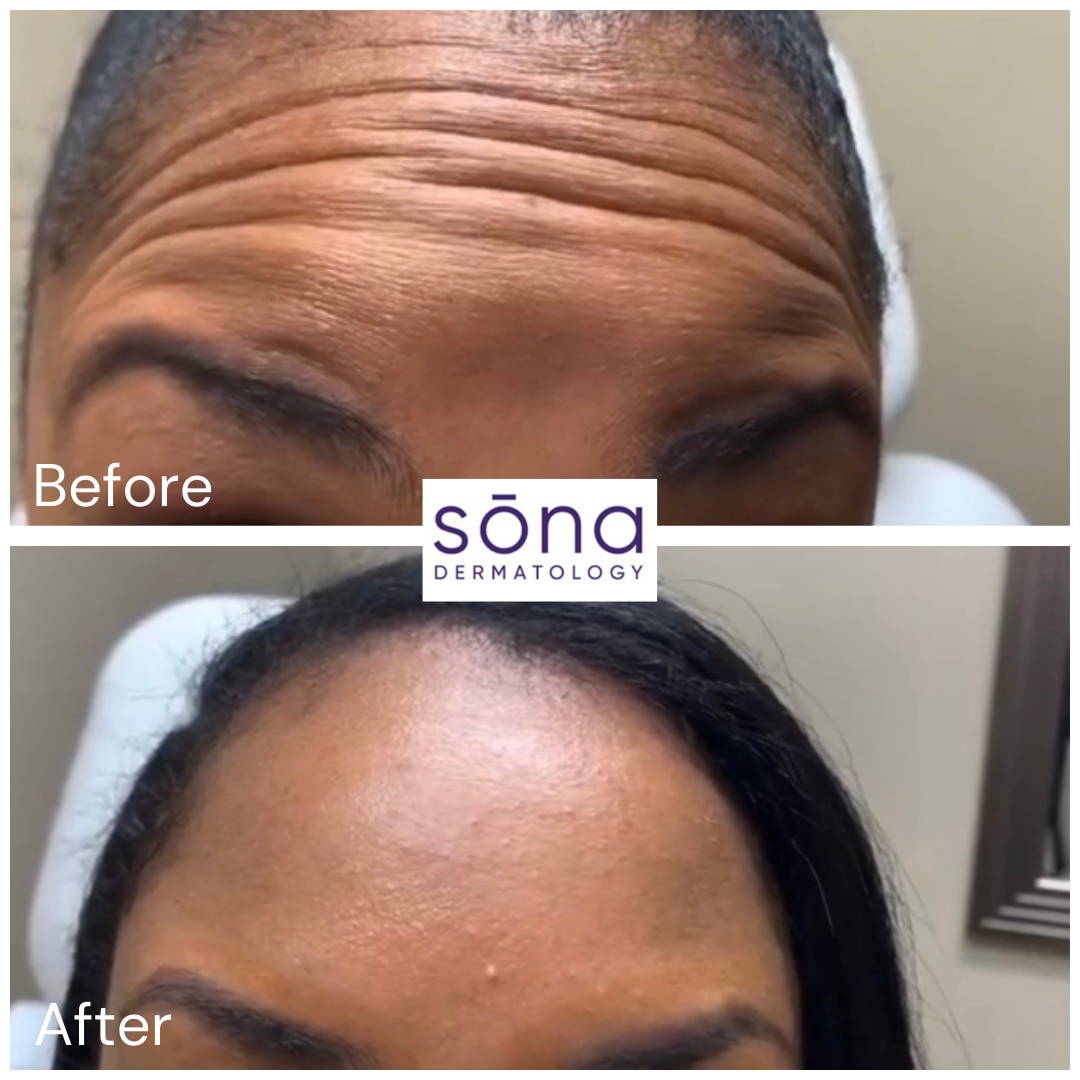Sona - Botox Cosmetic Before & After 4