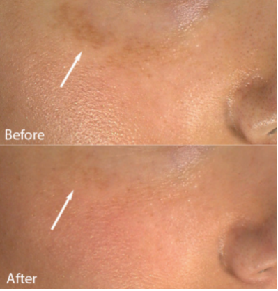 Before and After of Cheek Hyperpigmentation Using Skinuva Brite