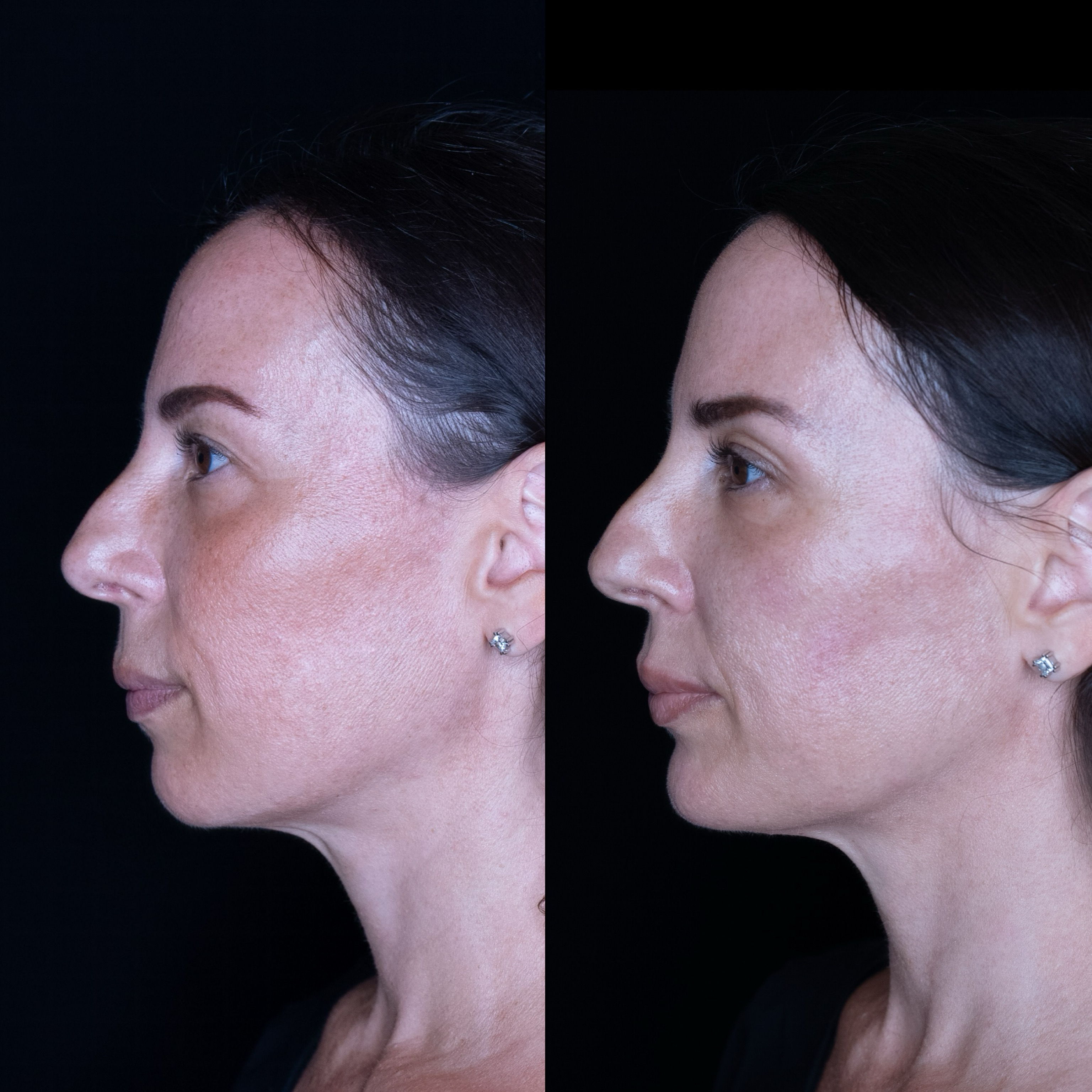 Profile comparison of a woman, showcasing two different angles.