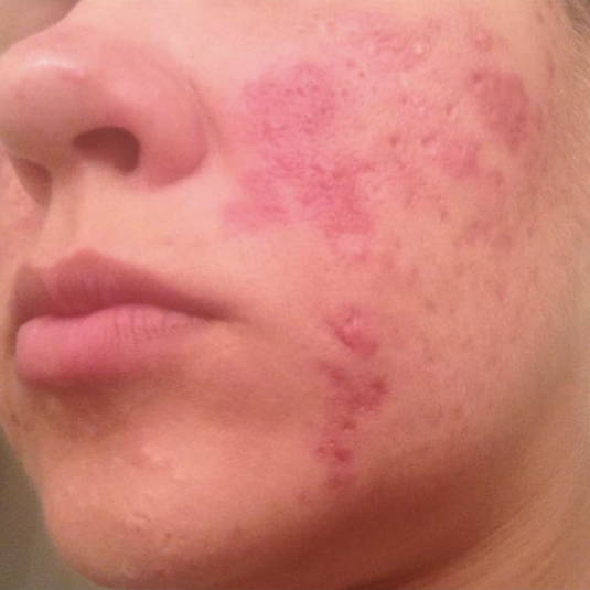 acne scar (after-2 weeks)